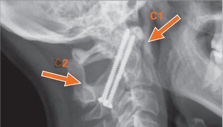 Instabilität bei Polyarthritis