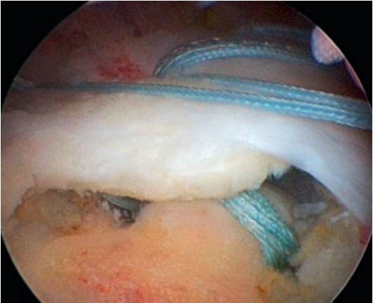 Arthroskopie Rotatorenmanschettenruptur