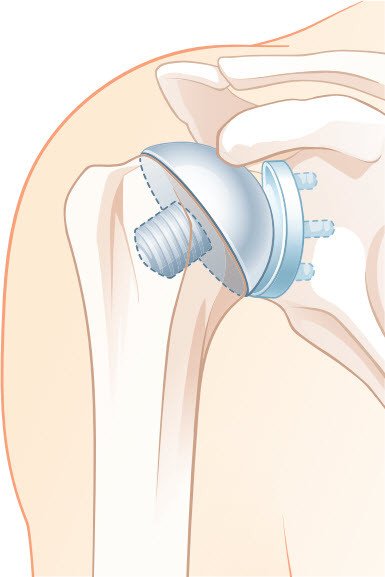 Schaftfreie anatomische Schulterprothese