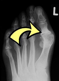 Die Röntgenaufnahme vor der Implantation des Kunstgelenkes zeigt die Arthrose des Grosszehengrundgelenkes.