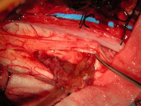 Mikrochirurgisches Ausschälen des Tumors