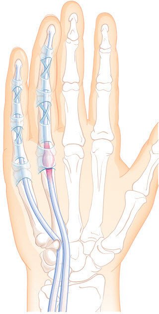 Schnellender Finger