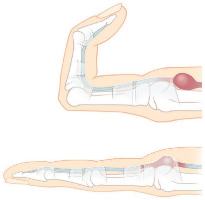Schnellender Finger Sehnenknoten