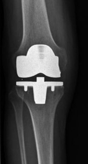 Knie-Totalprothese