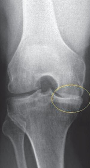 Lange wie schlittenprothese krank knie Künstliches Kniegelenk