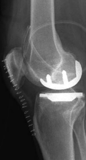 Röntgenbild Knie-Teilprothese, einen Tag nach der Operation