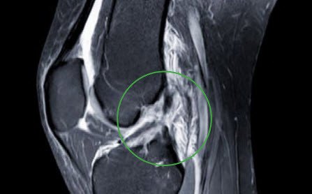 Kreuzbandriss MRI