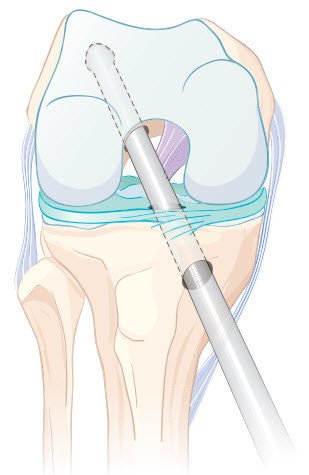 Kreuzbandriss Operation