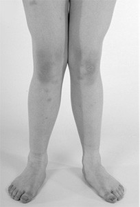 X Beine Behandlung Und Korrektur Schulthess Klinik