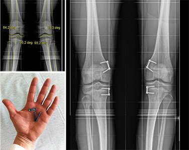 X-Beinkorrektur_Therapie