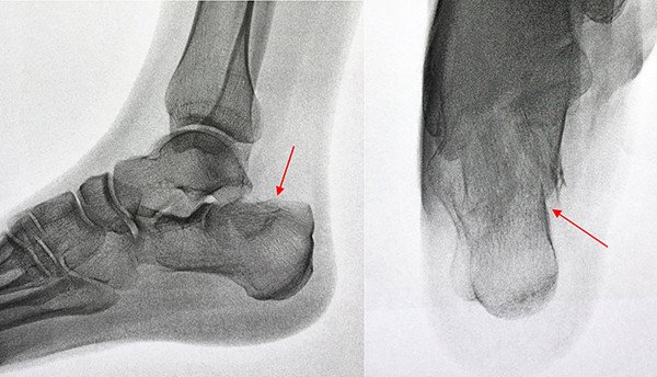 Arthrose Des Unteren Sprunggelenkes Nach Fraktur Des Fersenbeines Schulthess Klinik