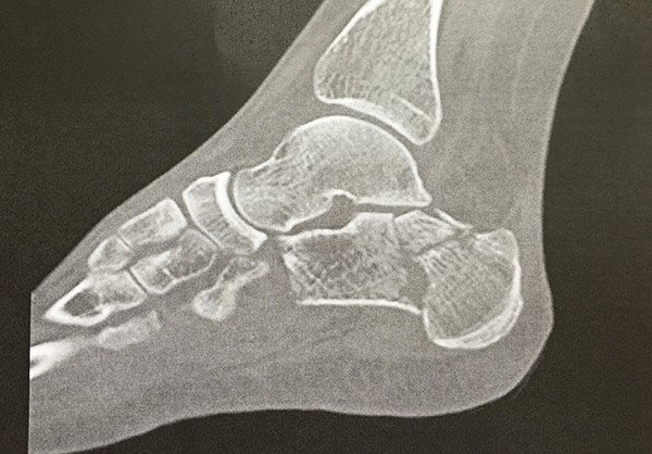 Arthrose Des Unteren Sprunggelenkes Nach Fraktur Des Fersenbeines Schulthess Klinik
