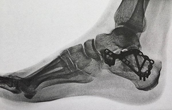 Arthrose Des Unteren Sprunggelenkes Nach Fraktur Des Fersenbeines Schulthess Klinik