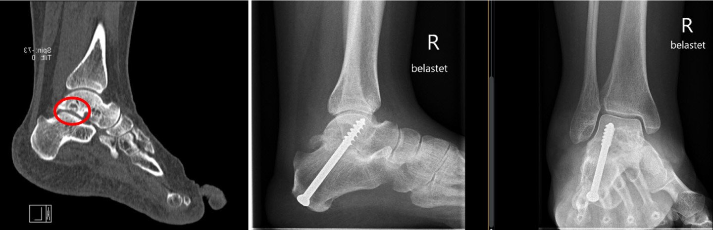 Arthrose Im Unteren Sprunggelenk Wenn Infiltrationen Nicht Mehr Helfen Schulthess Klinik