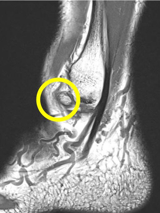 MRI akzessorischer Knochen Fuss