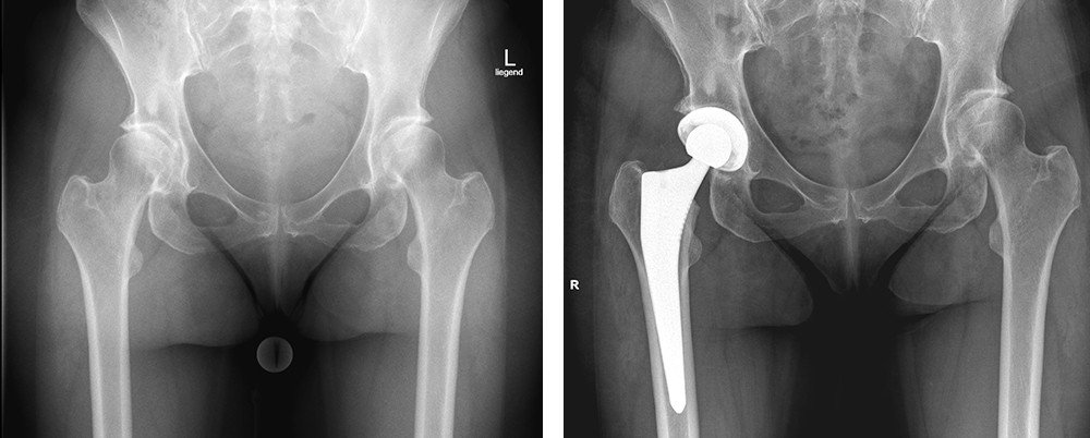 Röntgenbild Hüftarthrose vorher nachher mit Hüftprothese