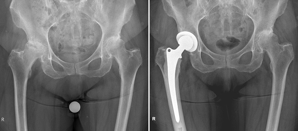 Röntgenbild Hüftarthrose vorher nachher mit Prothese