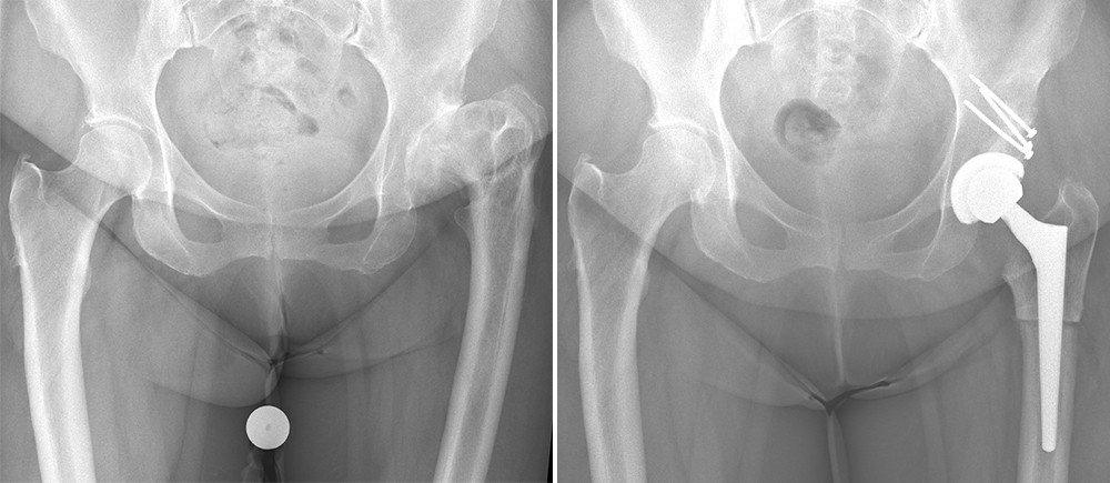 Röntgenbild Hüftarthrose vorher nachher mit Prothese