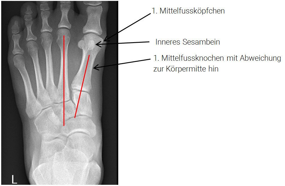 Röntgenbild juvenile Hallux valgus-Deformität