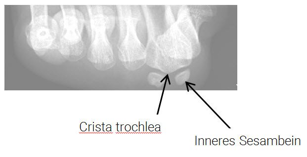 Röntgenbild Crista trochlea und inneres Sesambein