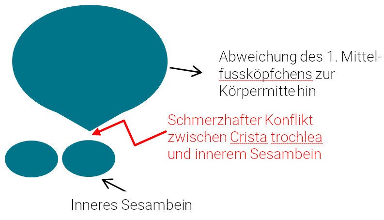 Schema schmerzhafter Konflikt zwischen innerem Sesambein und Crista trochlea