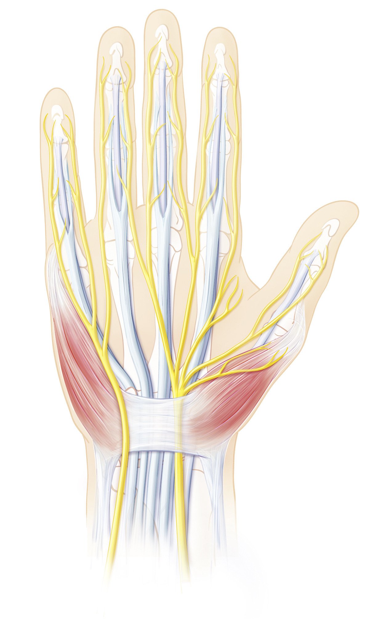 Karpaltunnelsyndrom oder Carpal-Tunnel-Syndrom mit Nervus Meridianus
