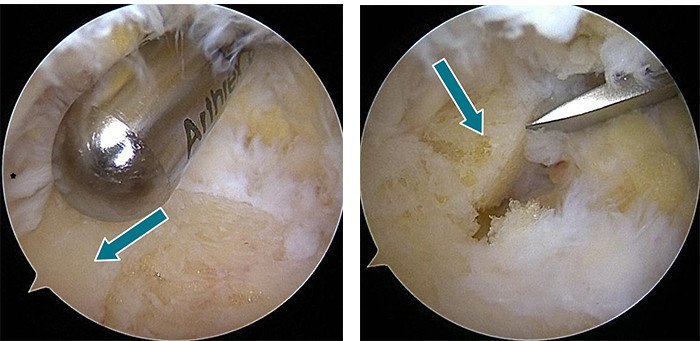 Minimal-invasive Behandlung einer Haglund-Ferse