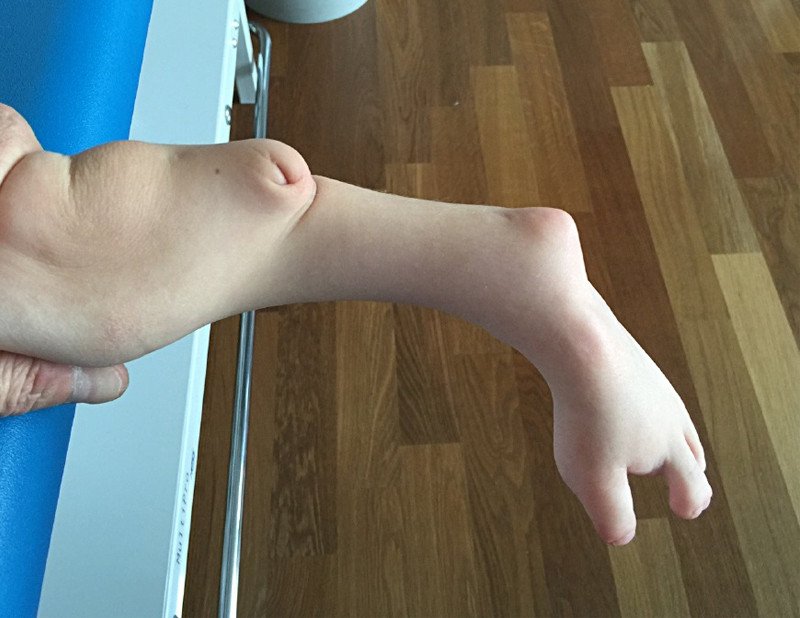 Tibiaaplasie