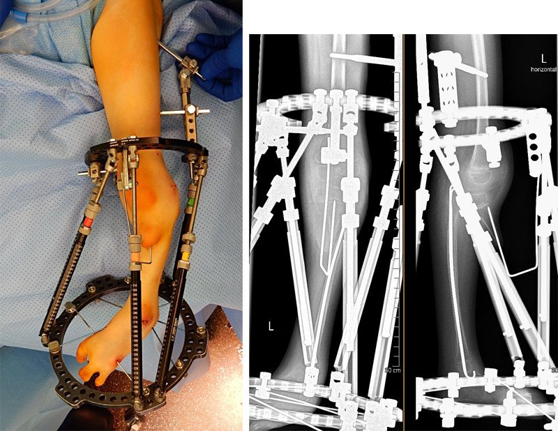 Rekonstruktion einer Tibiaaplasie mit äusserem Fixateur (Taylor Spatial Frame)