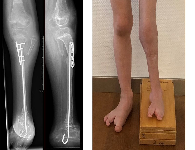 Röntgenbild nach Behandlung mit Taylor Spatial Frame Tibiaaplasie