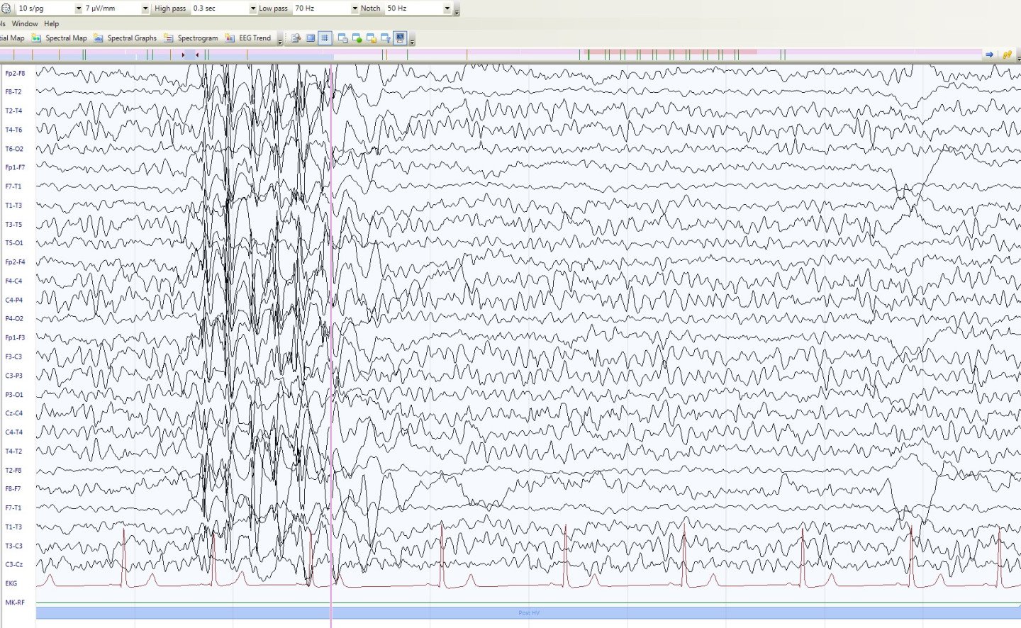 EEG beijuveniler Absence-Epilepsie nach der Hyperventilation