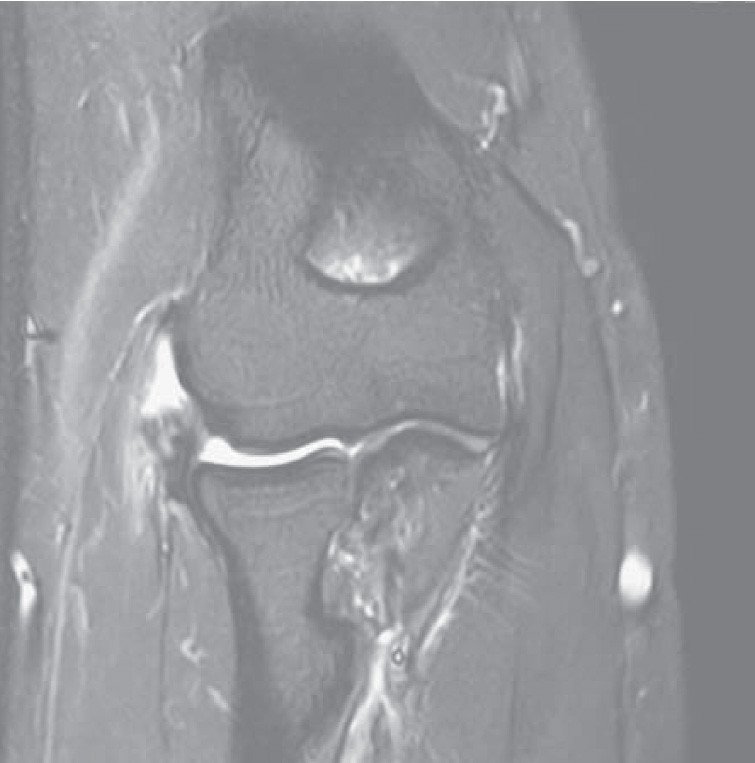 MRI-Bild Tennisarm mit gerissener Sehne