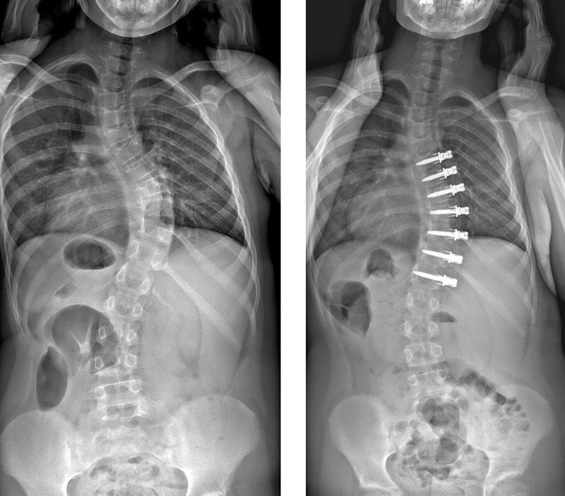 Röntgenbilder, vor und nach bewegungserhaltender Skoliose-Operation