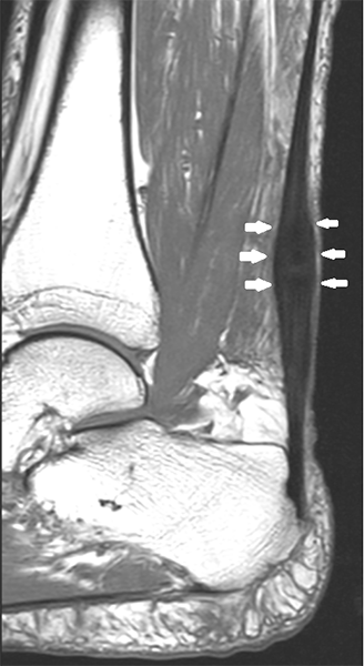 Achillodynie MRI