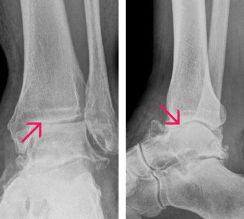 Röntgenbilder eines Fussgelenks mit fortgeschrittener Arthrose