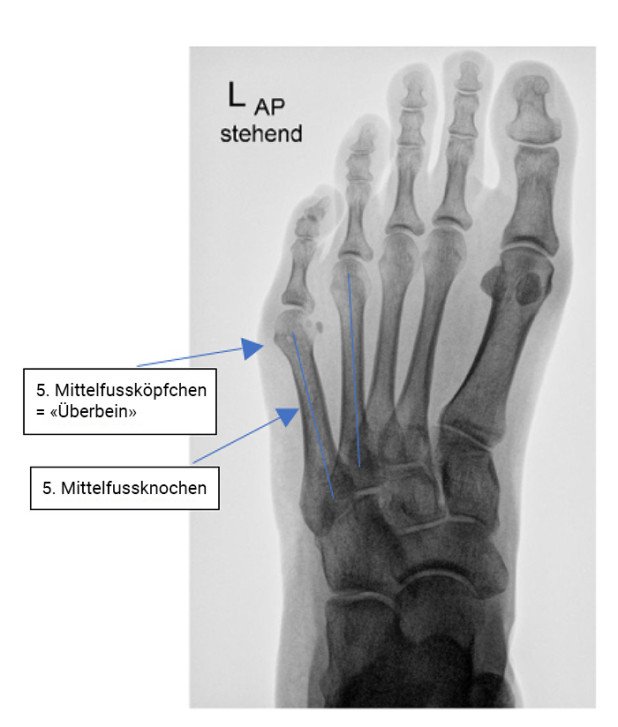 Bunionette-Deformität