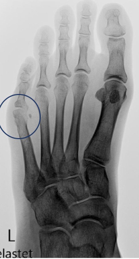 Zustand nach Abtragung des «Überbeines»