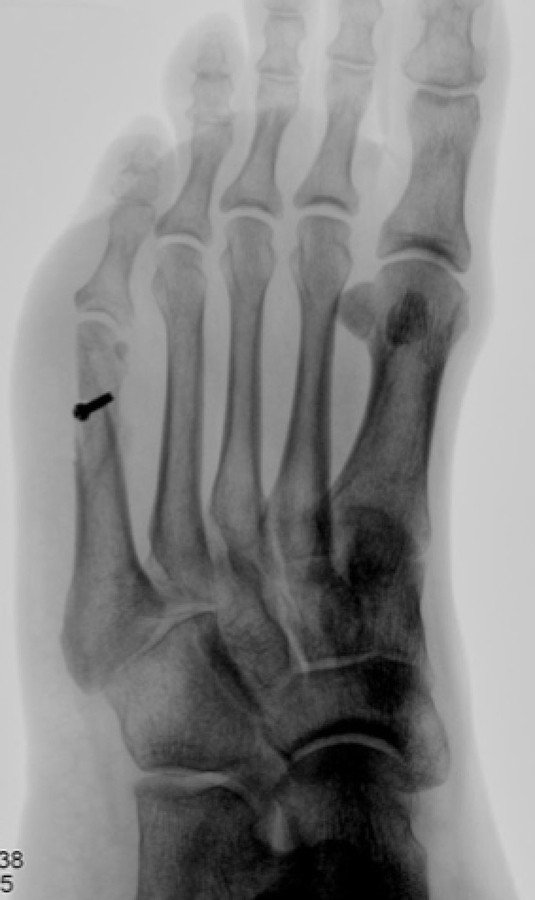 Röntgenaufnahme vom linken Fuss