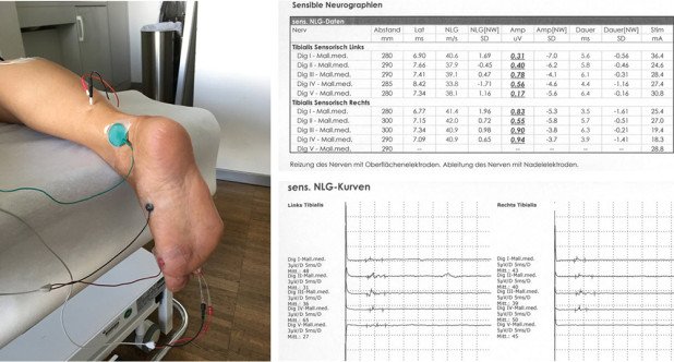 Ultraschall-unterstützten Positionierung der Ableitnadeln