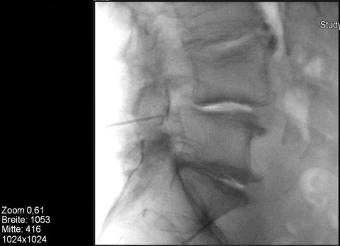 Epidurale interlaminäre Infiltration