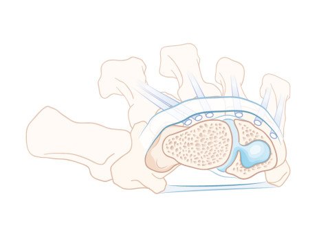 Ganglion mit Ursprung zwischen Kahn- und Mondbein