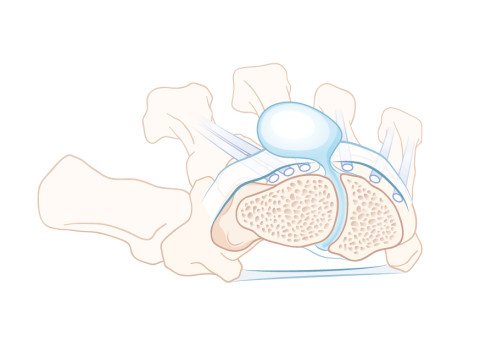 Ganglion mit Wachstum in den Knochen