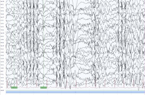 EEG bei juveniler Absence-Epilepsie während Hyperventilation