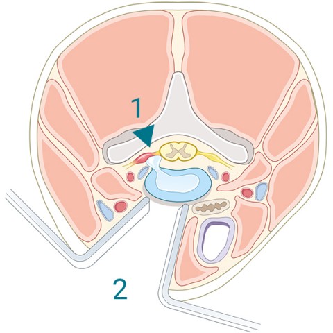 eingeklemmte Nervenwurzel Bandscheibe