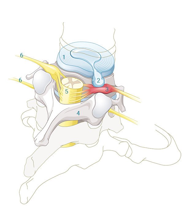 Anatomie Bandscheibe bei Diskushernie