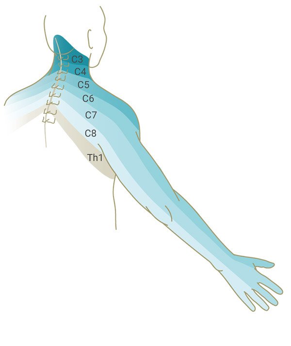 Schmerzausbreitung Bandscheibenvorfall