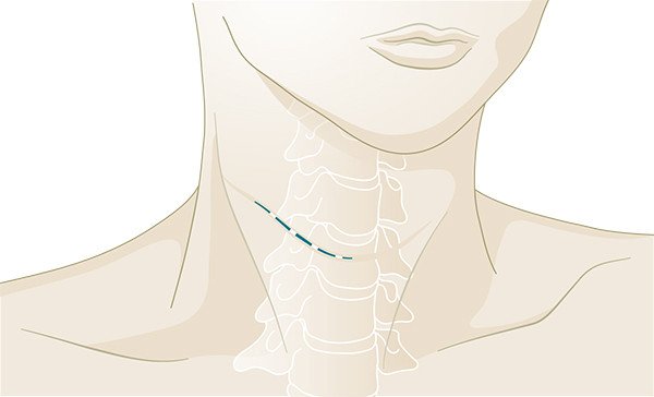 Operation Bandscheibe Zugang