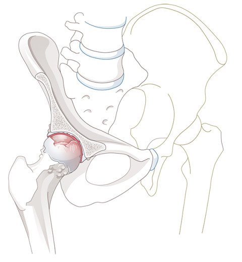 Hüftarthrose