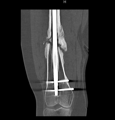 CT Pseudoarthrose im Oberschenkel