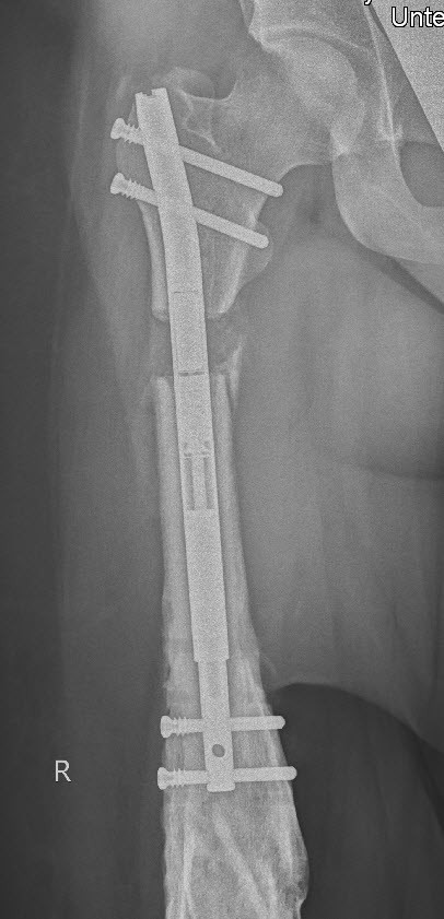 CT Marknagel in Oberschenkelknochen